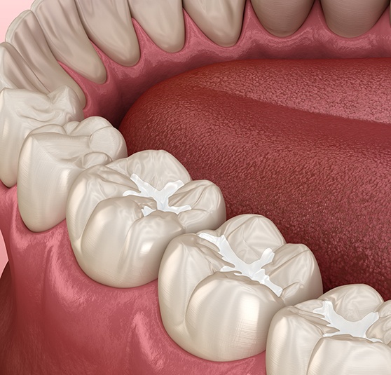 Tooth-colored fillings