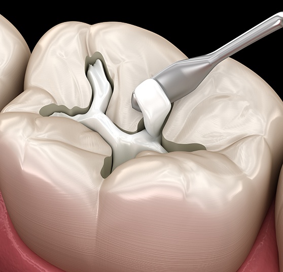 Digital image of a tooth-colored filling being put in place